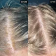 Salicylic Acid Exfoliating Scalp Treatment1