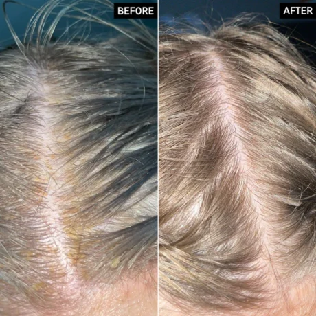 Salicylic Acid Exfoliating Scalp Treatment1