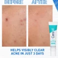 Acne Control Gelss