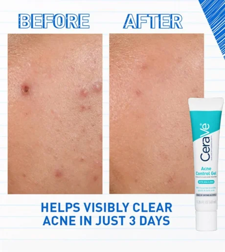 Acne Control Gelss