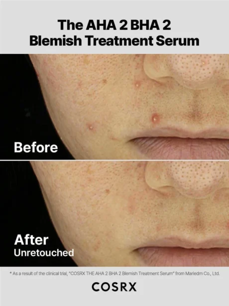 The AHA 2 BHA 2 Blemish Treatment Serumss