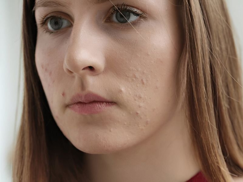 teen age acne 