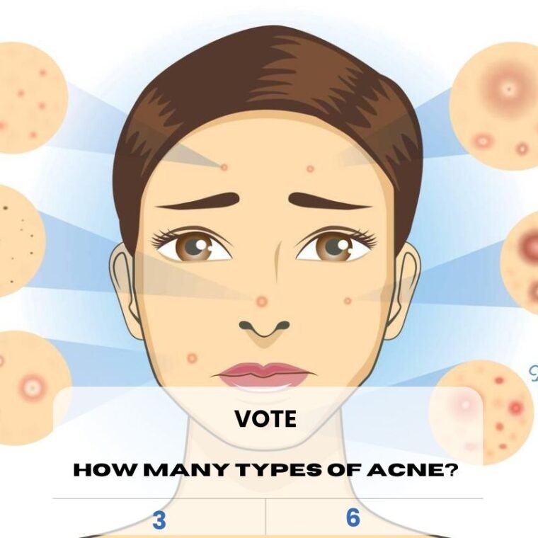 types of acne