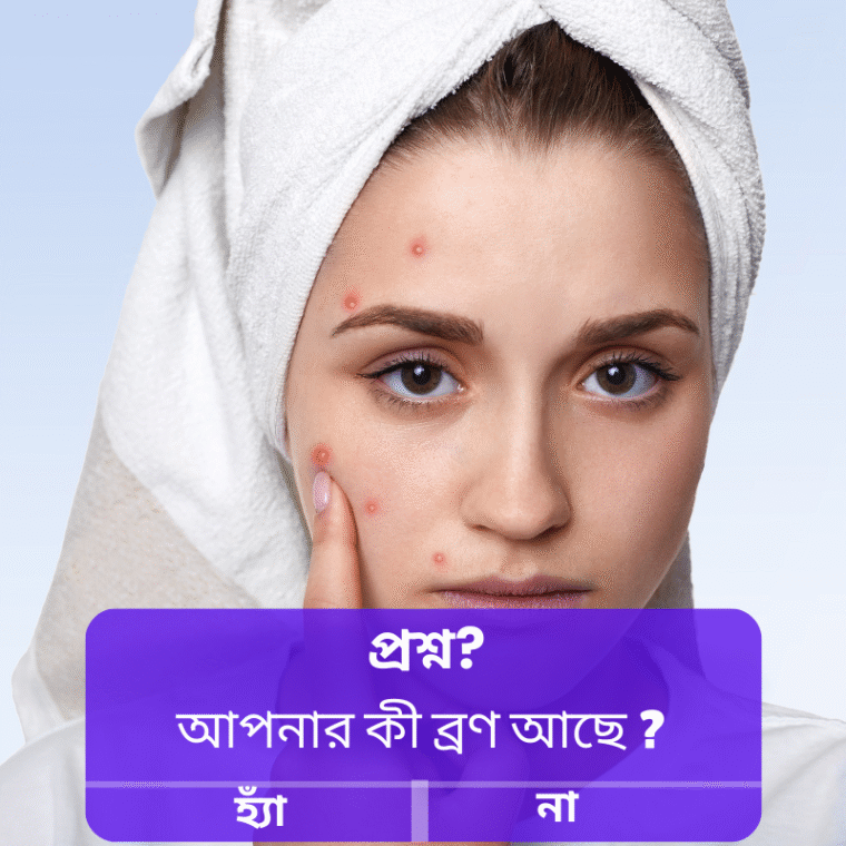 Acne treatment in Bangla