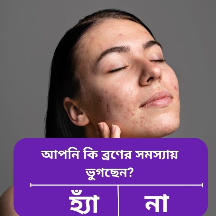 ব্রণ প্রবণ ত্বকের জন্য সঠিক স্কিনকেয়ার রুটিন ও টিপস