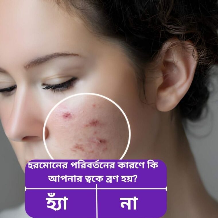 হরমোনজনিত ব্রণ নিয়ন্ত্রণের সহজ ঘরোয়া উপায় – Natural Remedies Guide